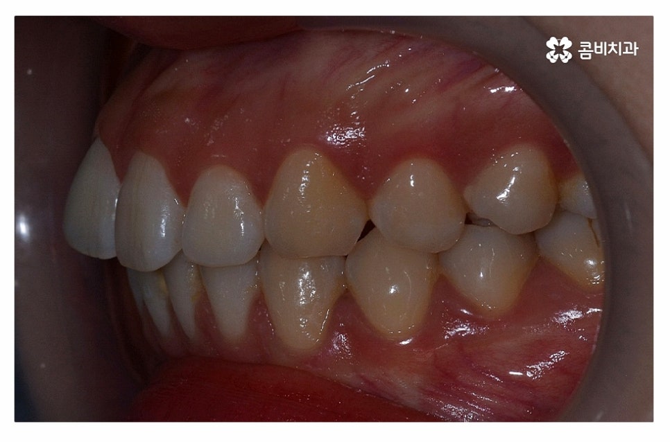 돌출입치아교정 적극적으로 해결하려면 관련 이미지 3