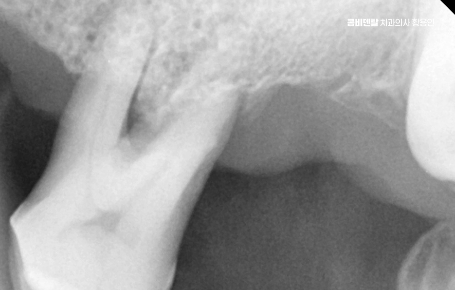 윗니 전체 임플란트 뭐부터 해야할까 관련 이미지 7