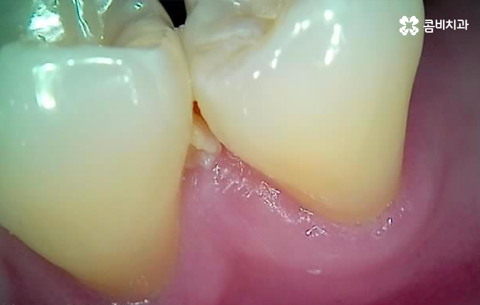충치 신경치료 안하면 후회하는 이유 관련 이미지 4