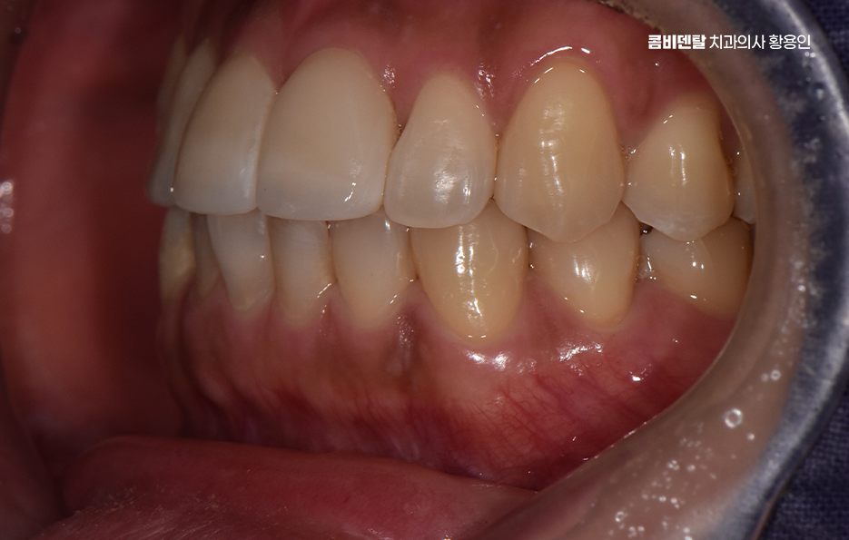 How to Use Laminate Veneers for Chipped Front Teeth image 10