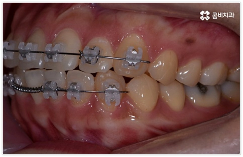 앞니부분교정 누구나 할수있나요? 관련 이미지 11