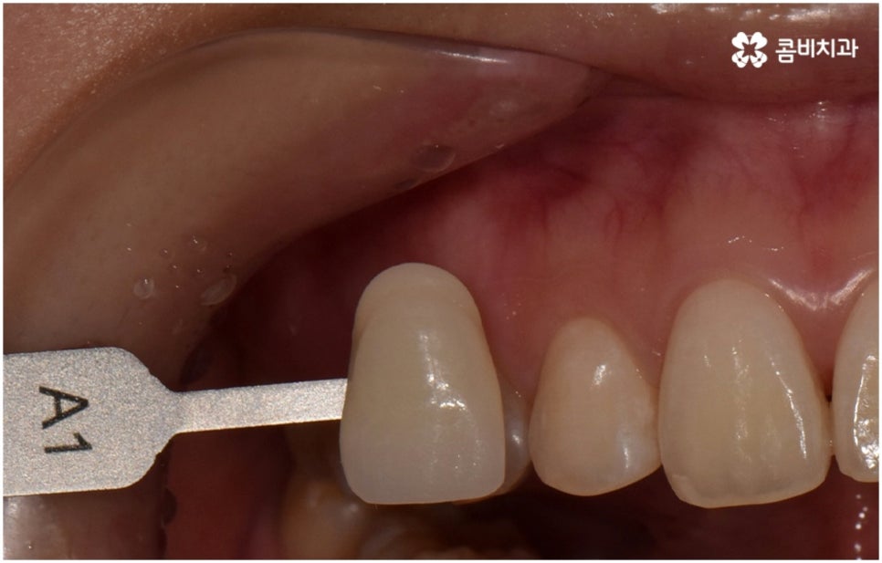 누런치아 하얗게 바꾸고 싶다면 관련 이미지 8