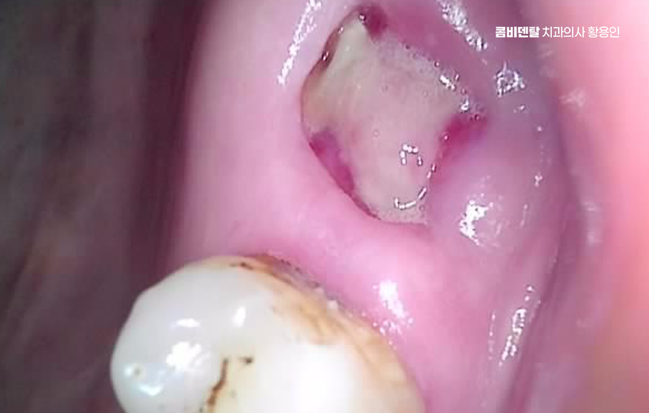 어금니 없으면 얼굴 발음에 어느정도나 안좋을까 관련 이미지 2