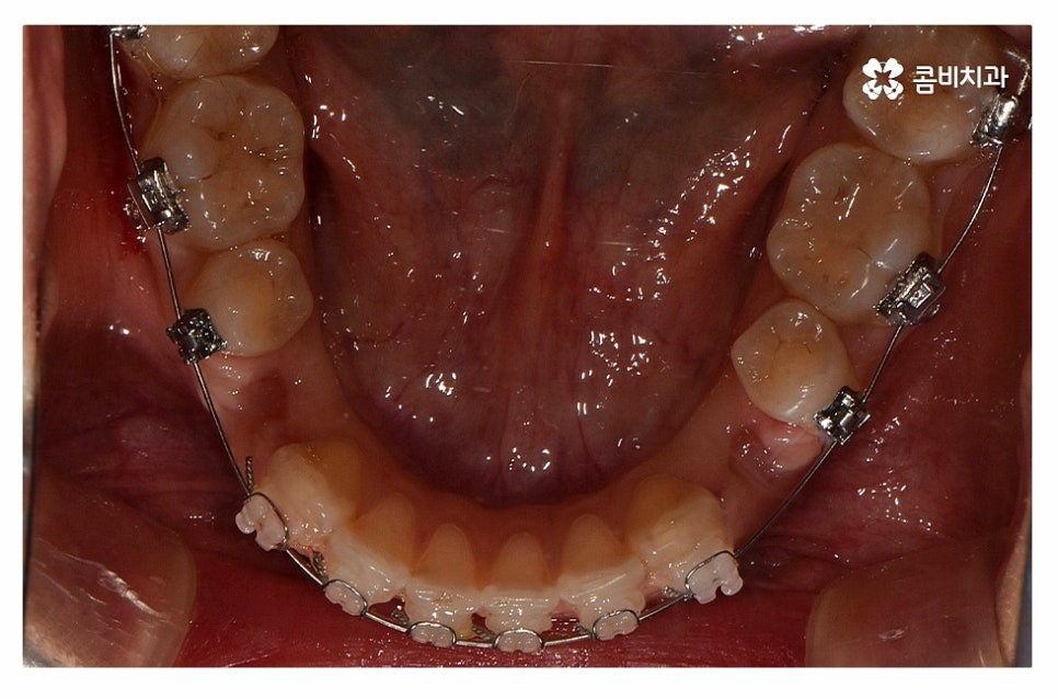 돌출입치아교정 적극적으로 해결하려면 관련 이미지 10