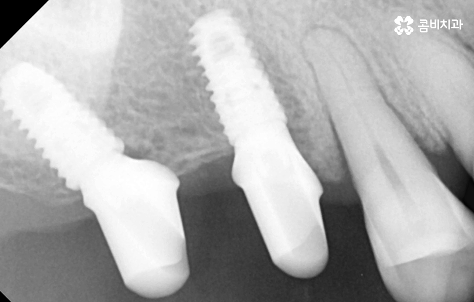어금니 임플란트 기간 얼마나 예상해야 하나요 관련 이미지 7