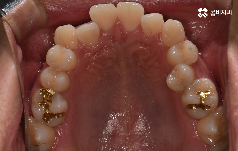 30대 치아교정 빨리 끝내고 싶어요 관련 이미지 4