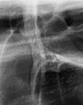 어금니 뒤 잇몸 부음 어떤 문제길래 이런거죠 관련 이미지 10