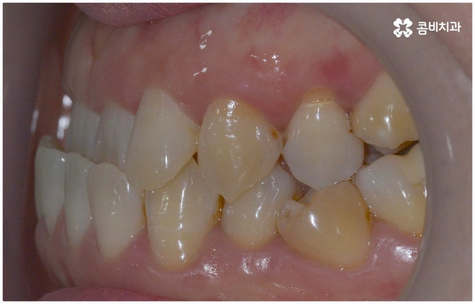 반대교합교정 늦지 않았어요 관련 이미지 5