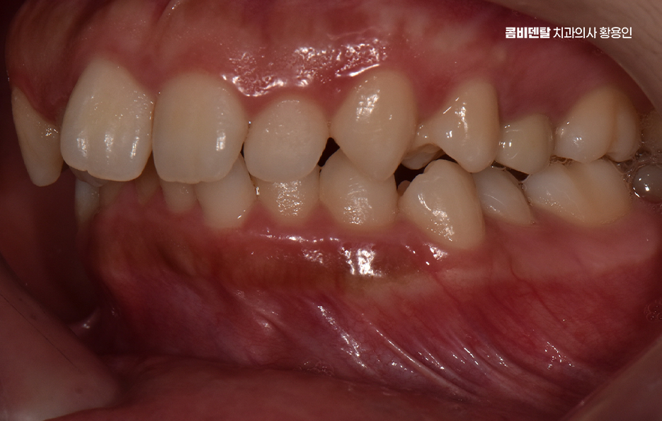 비발치 돌출입 교정 어떨때 적절할까 관련 이미지 4