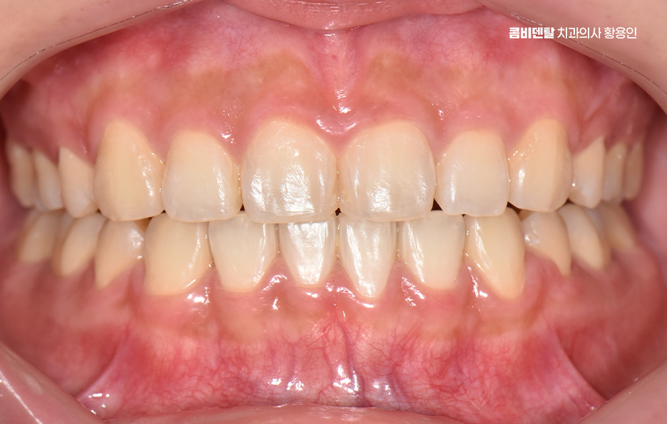 과개교합 교정 후 얼굴형 얼마나 바뀌나요 관련 이미지 9