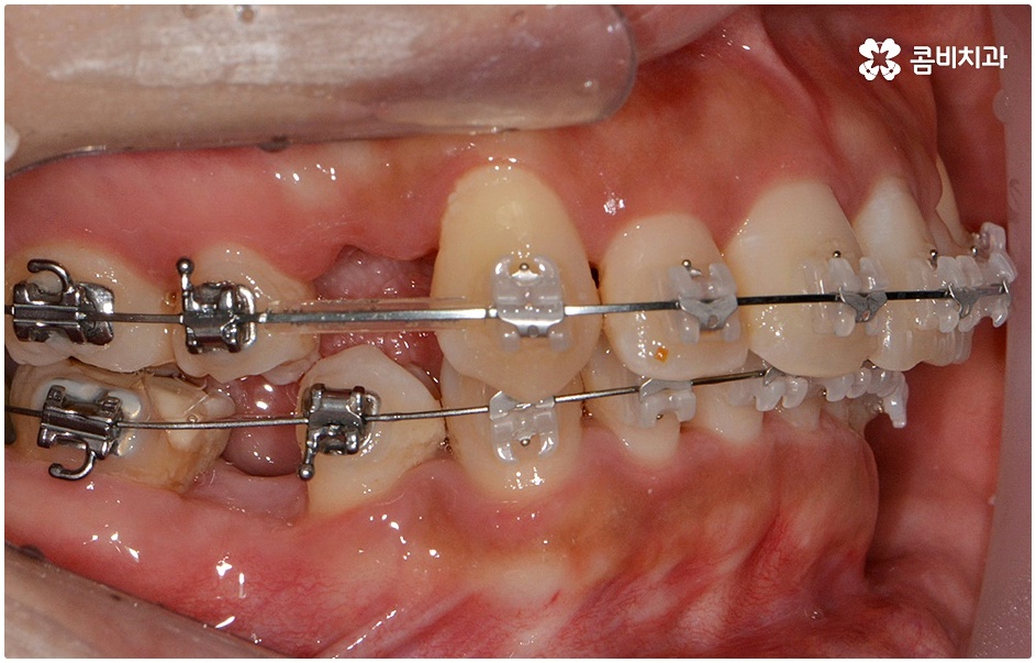돌출치아교정 언제가 좋을까요 관련 이미지 6