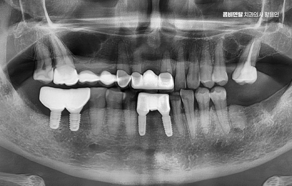 임플란트의 장점 할까 말까 고민이신 분들을 위한 정리 관련 이미지 8