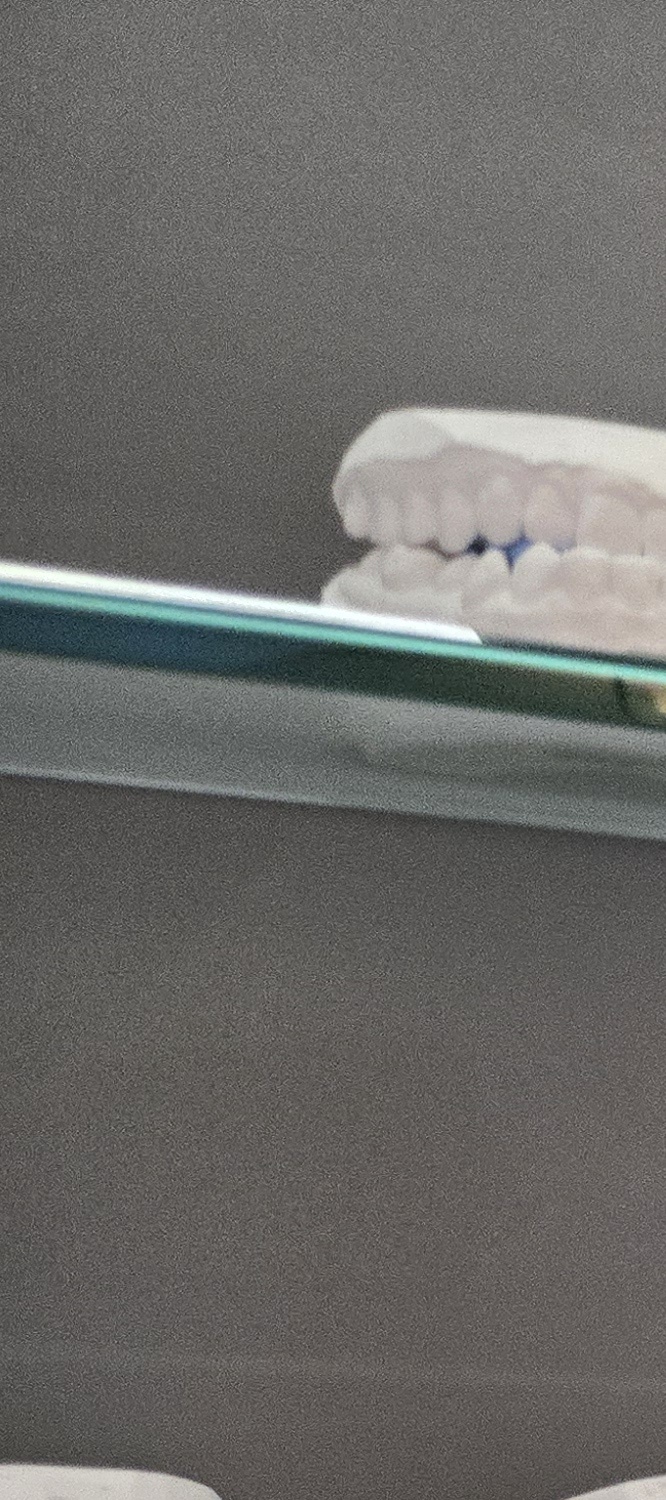 앞니 틀어짐 교정 이렇게 파악하세요 관련 이미지 10