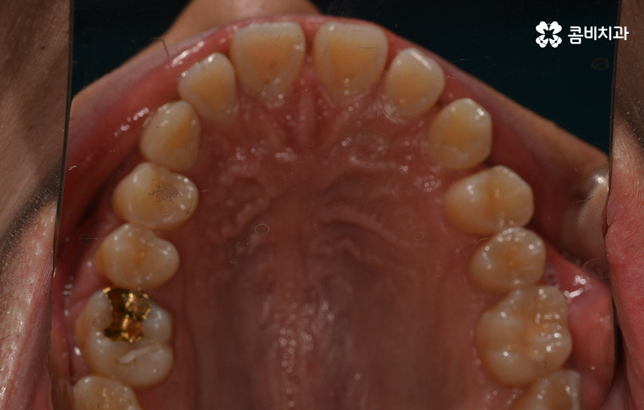 치아부분교정 내게도 적합한지 알아보려면 관련 이미지 4