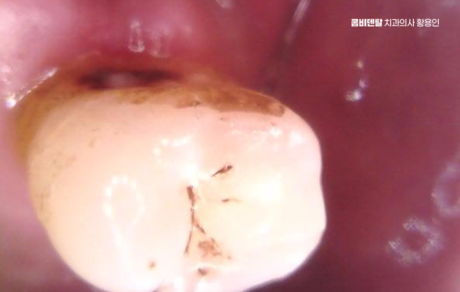 어금니 없으면 얼굴 발음에 어느정도나 안좋을까 관련 이미지 8