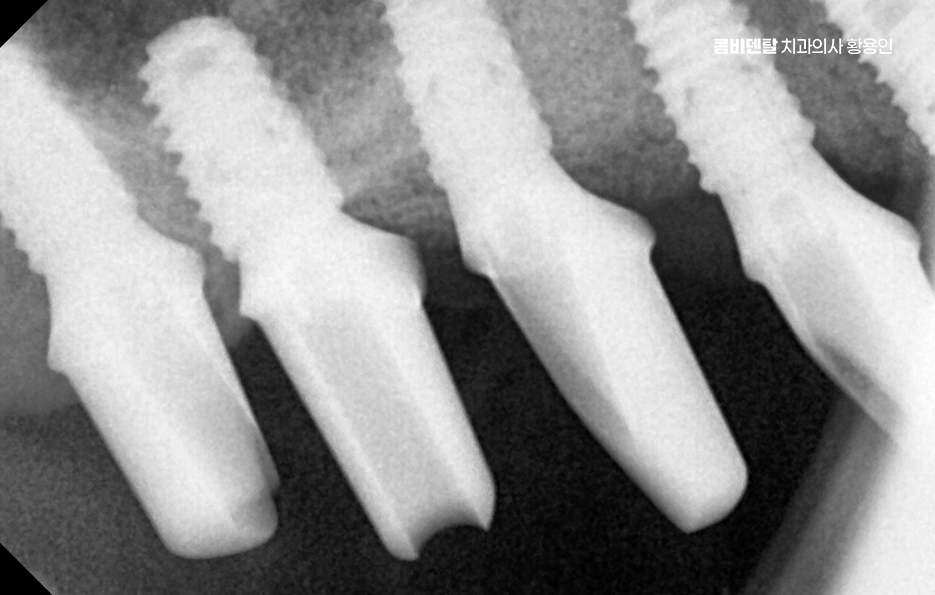 어금니 임플란트 뼈이식 이럴때 해당됩니다 관련 이미지 9