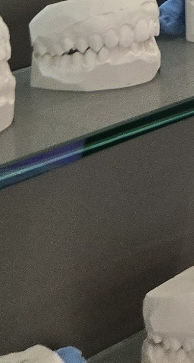 완전매복사랑니 발치 대학병원 꼭 가야하나요 관련 이미지 42