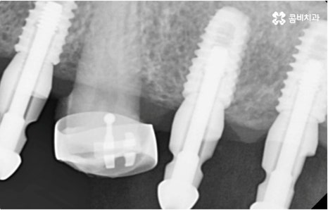 명동치과 타고난 이의 수명은 관련 이미지 11