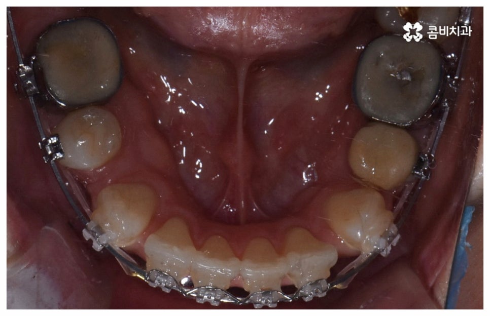 중년치아교정 원한다면 관련 이미지 14