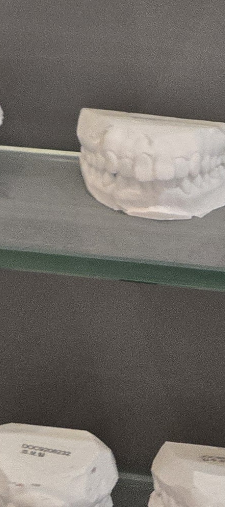 앞이빨 임플란트 과정 주의해야할 포인트는 관련 이미지 32