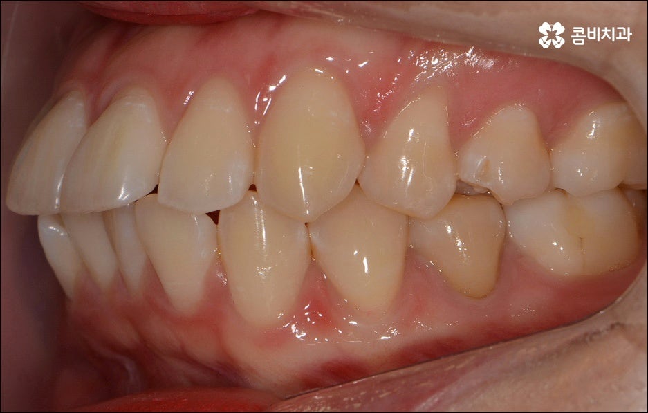 앞니 돌출 어떻게 고치나요? 관련 이미지 6