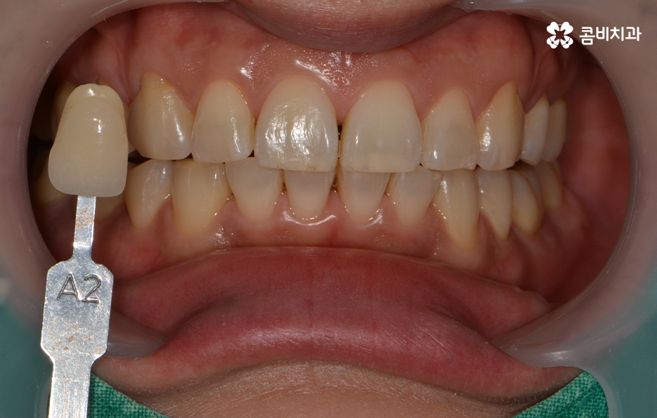 치과미백치료 누런 이가 고민되신다면 관련 이미지 2