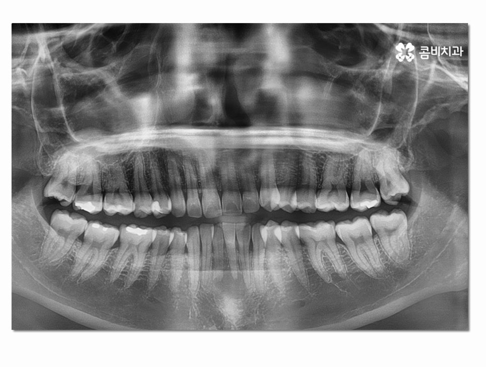 치주염으로 인한 아랫니 임플란트 절차를 알아보면 관련 이미지 2