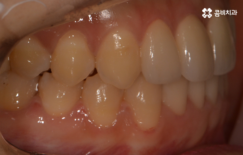 앞니 깨짐 치료와 교정이 병행되었던 사례 관련 이미지 11