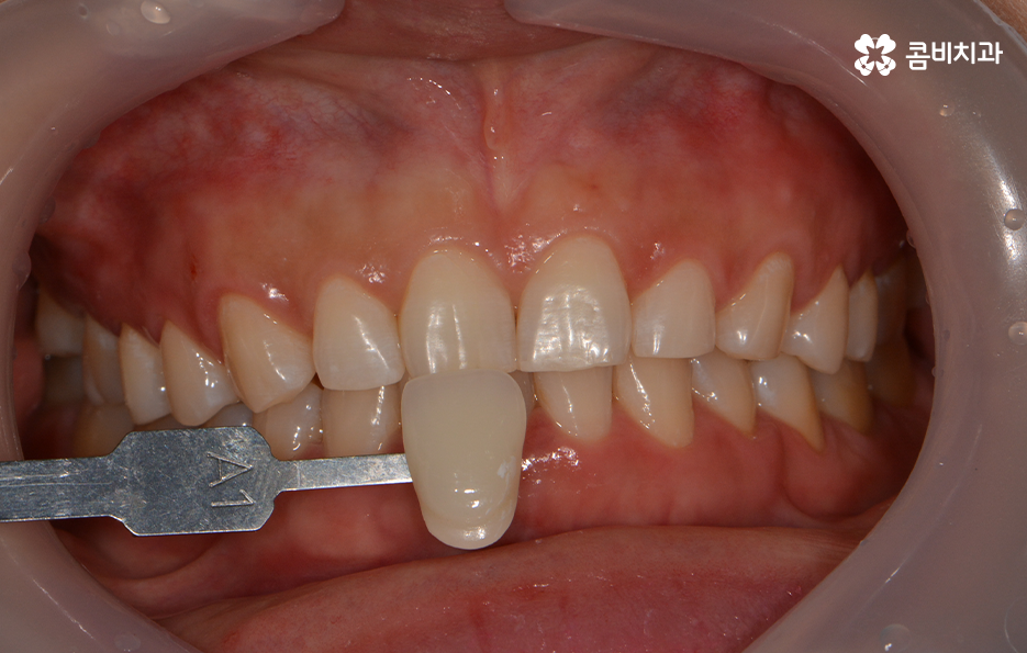 치과치아미백 어떻게 다른지 설명해드려요 관련 이미지 7