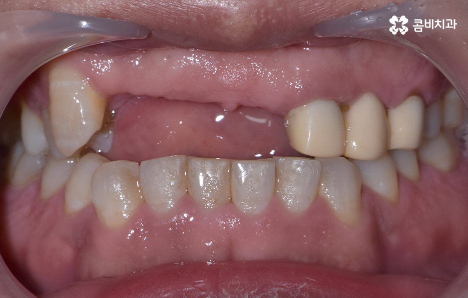 앞이빨 임플란트 과정 주의해야할 포인트는 관련 이미지 3