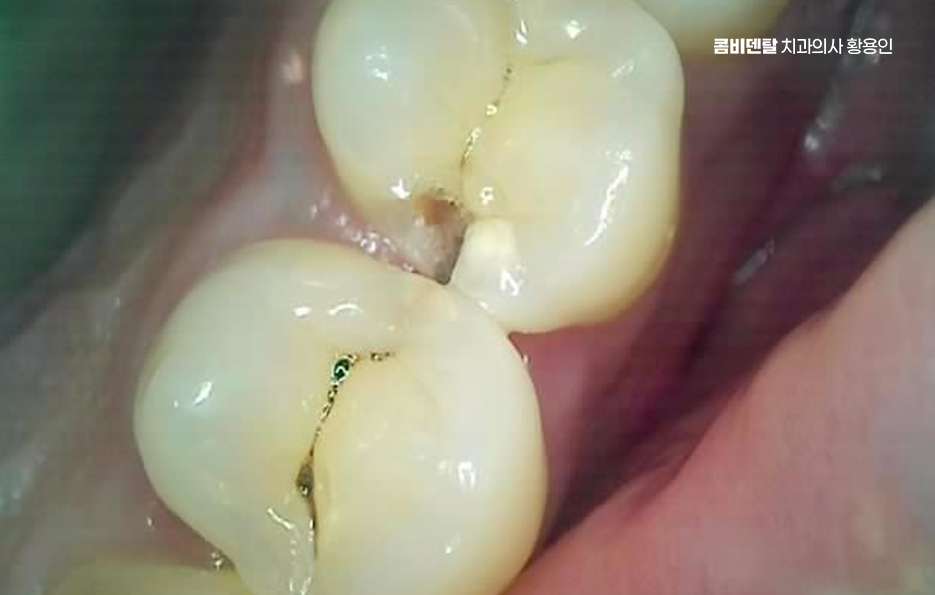 충치 치아 깨짐 시점이 관건이라면 관련 이미지 2