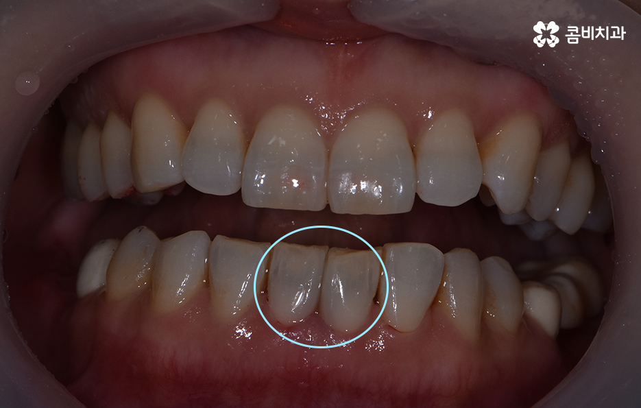 블랙트라이앵글 레진으로 해결한 사례 관련 이미지 2