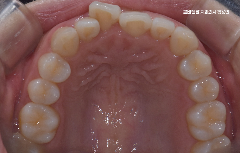 치아교정 통증 줄이는 방법 어떻게 가능할까요 관련 이미지 5