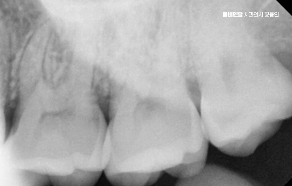 아래 사랑니 발치 통증 미리 알고 대처하려면 관련 이미지 4