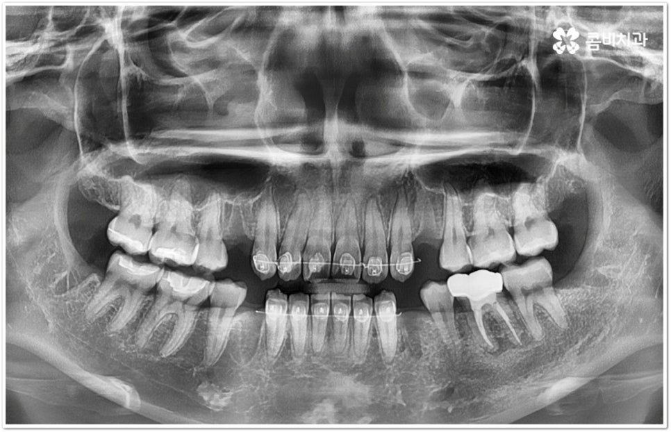 아래사랑니발치 망설이고 있다면 관련 이미지 2