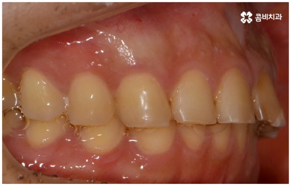앞니충치치료 어떻게 이뤄지나요 관련 이미지 2