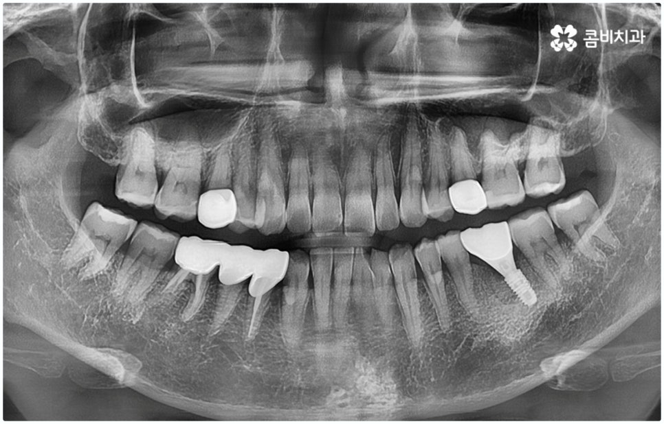 원데이임플란트 받고 싶으신가요? 관련 이미지 11