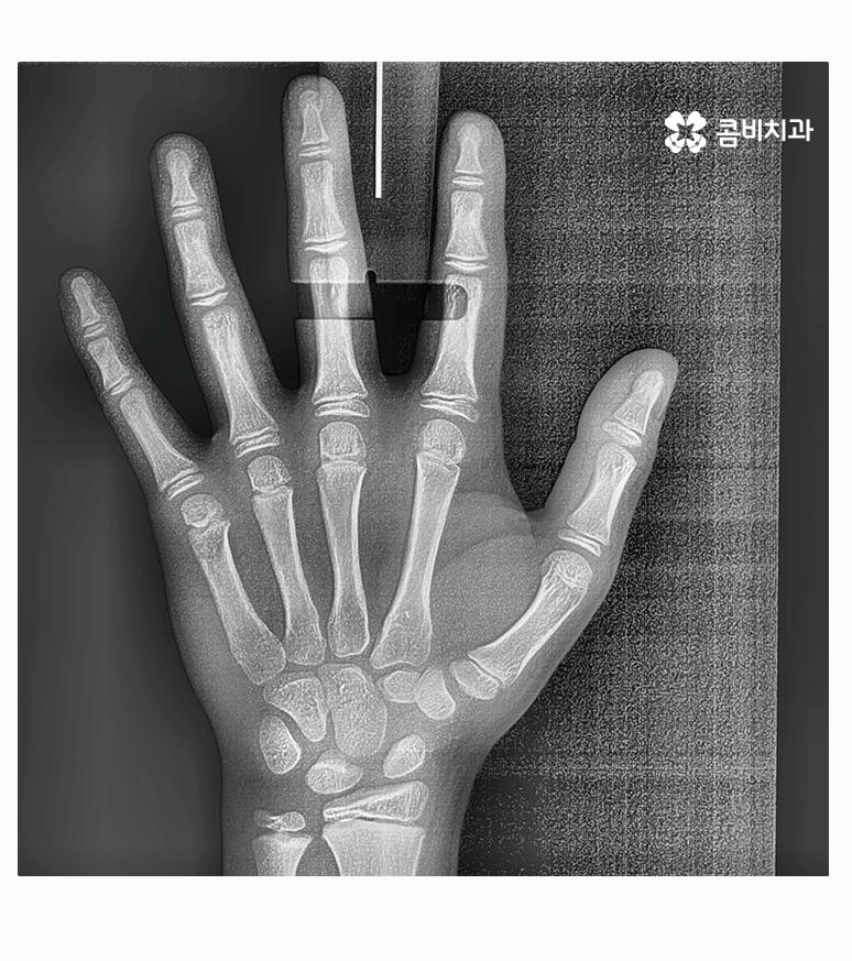 과개교합교정 어릴때 고쳐주면 좋은 사례 관련 이미지 7