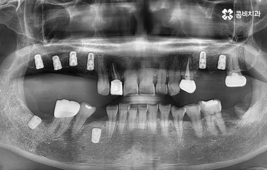 임플란트 치료기간 어느정도 걸리고 치과에는 몇번 가나요 관련 이미지 7