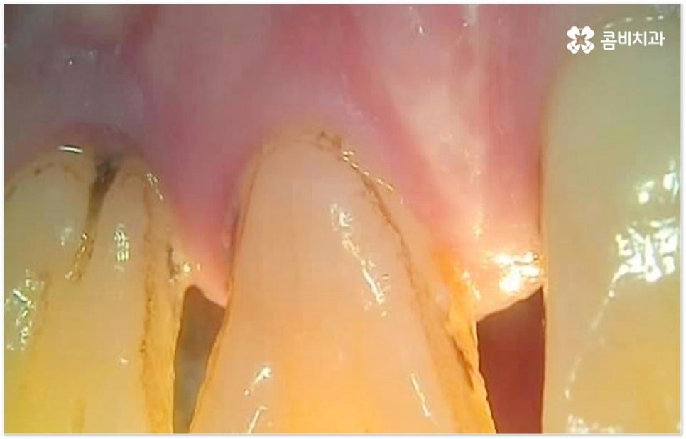 뼈이식임플란트 언제하나요? 관련 이미지 1