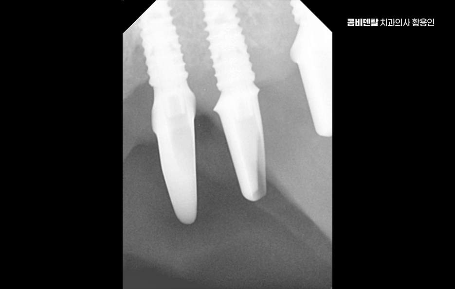 If You’re Considering Full Upper-Arch Implants for the Long Term image 10