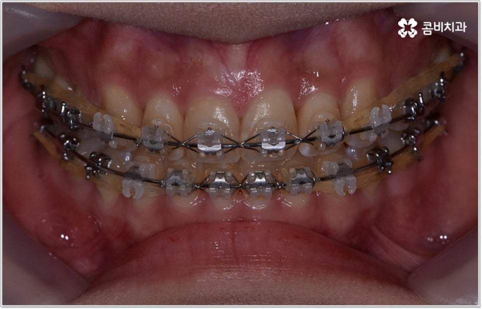 비발치치아교정 언제 할수있나요 관련 이미지 7