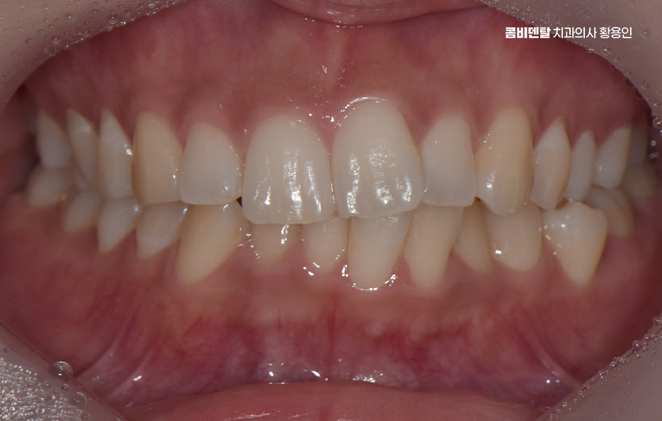 앞니 틀어짐 교정 이렇게 파악하세요 관련 이미지 2