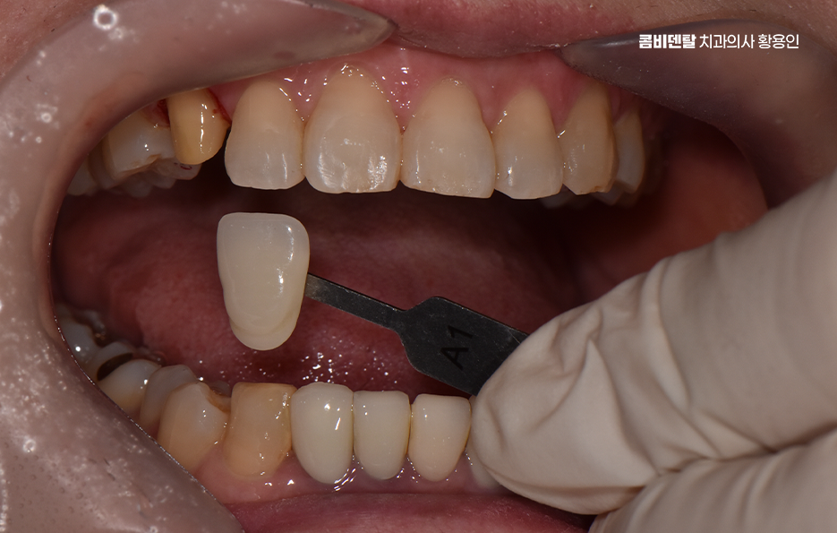 송곳니 크라운 티가 안나게 해결 가능한건가요 관련 이미지 1