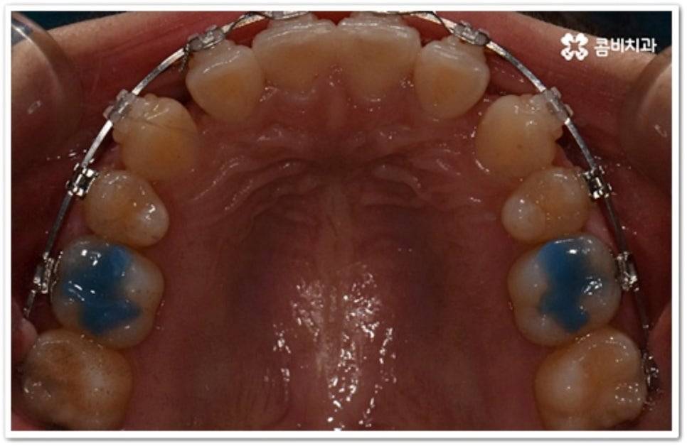 덧니 발치 언제 하나요? 관련 이미지 8
