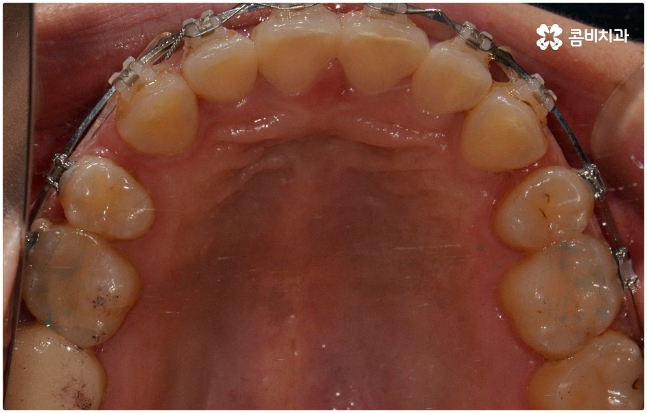돌출치아교정 언제가 좋을까요 관련 이미지 8