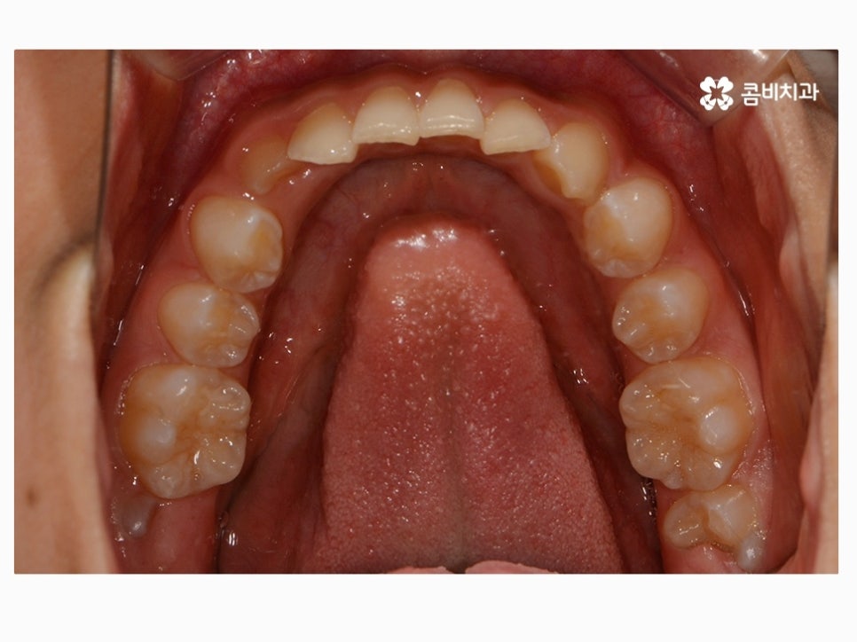 과개교합교정 어릴때 고쳐주면 좋은 사례 관련 이미지 5