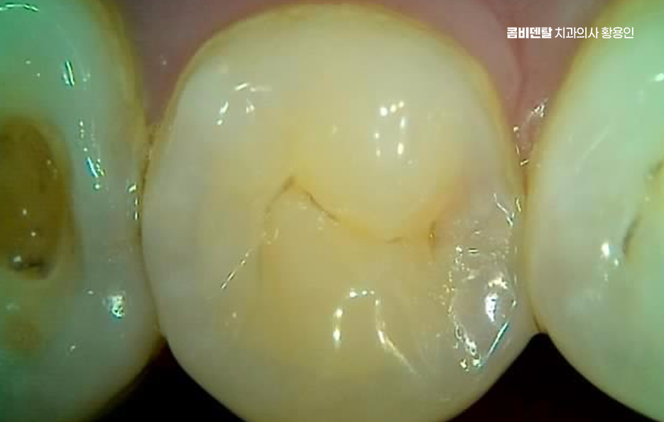어금니 충치 단계 미리 알아차리려면 관련 이미지 11