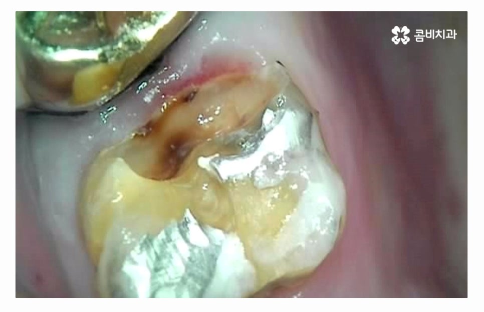 임플란트수술 제대로 알고 선택하려면 관련 이미지 4