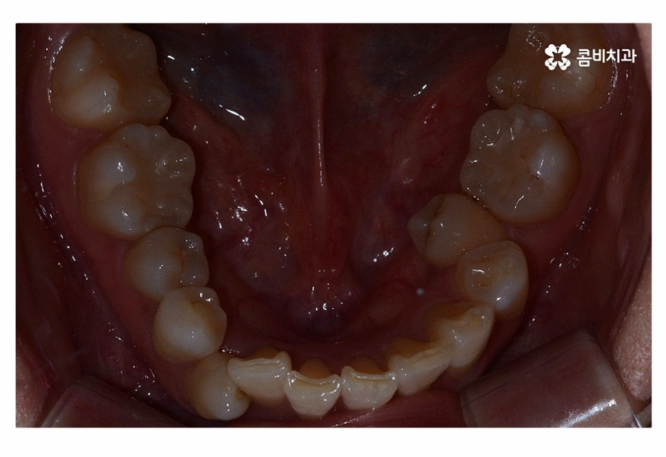 치아설측교정 가능한지 궁금하다면 관련 이미지 4
